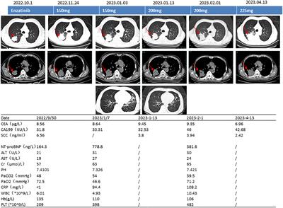 Case Report: A rare case of non-small cell lung cancer with STRN-ALK fusion in a patient in very poor condition treated with first-line ensartinib